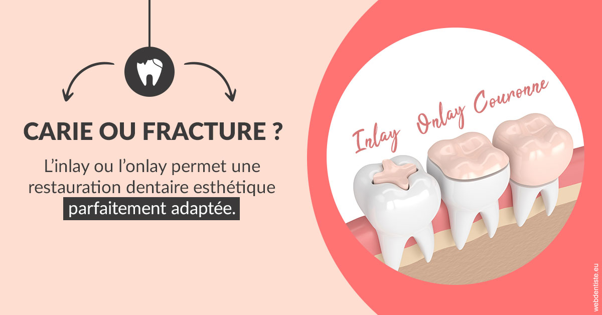 https://dr-tapiero-steeve.chirurgiens-dentistes.fr/T2 2023 - Carie ou fracture 2