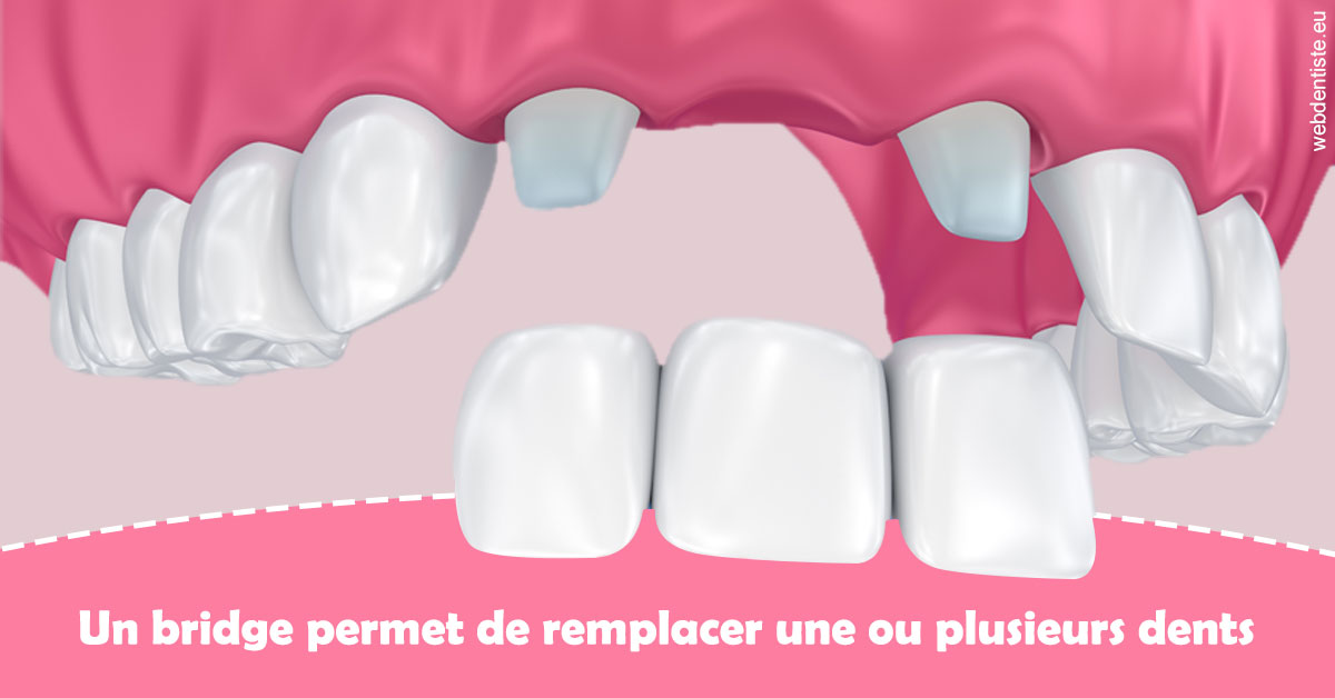 https://dr-tapiero-steeve.chirurgiens-dentistes.fr/Bridge remplacer dents 2