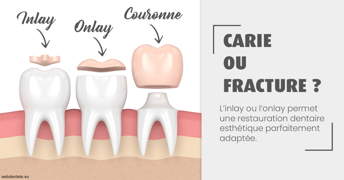 https://dr-tapiero-steeve.chirurgiens-dentistes.fr/T2 2023 - Carie ou fracture 1