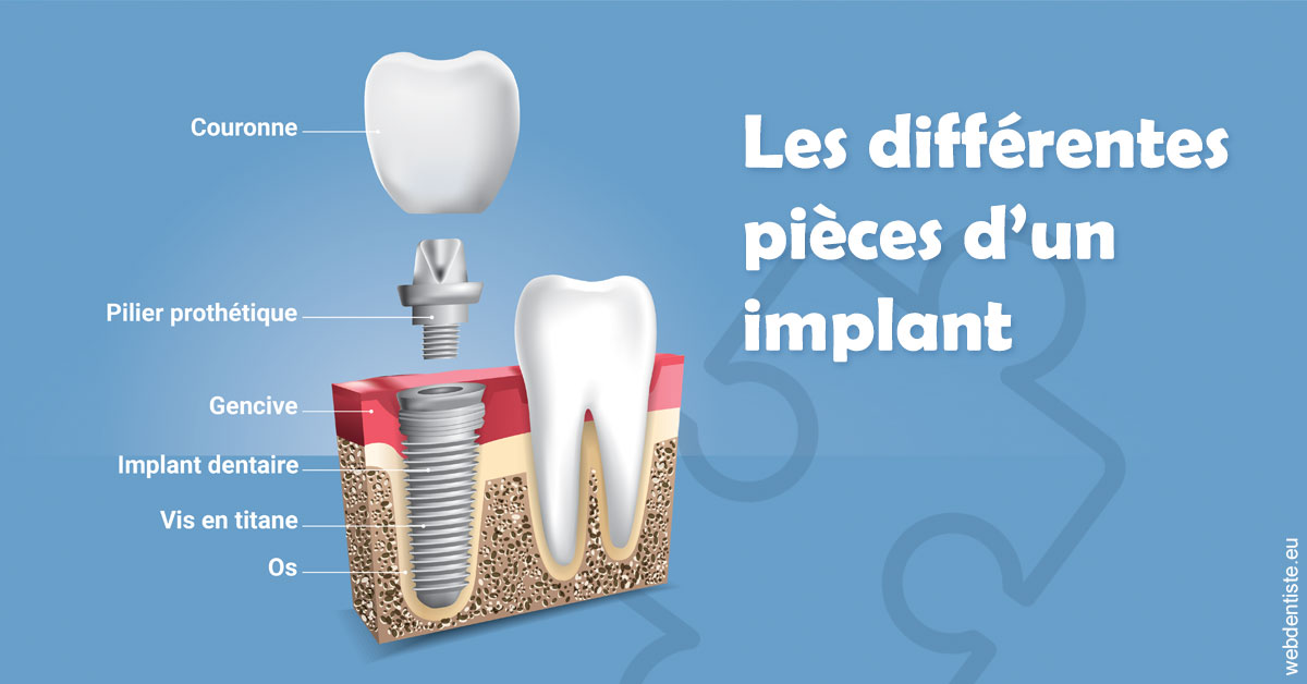 https://dr-tapiero-steeve.chirurgiens-dentistes.fr/Les différentes pièces d’un implant 1